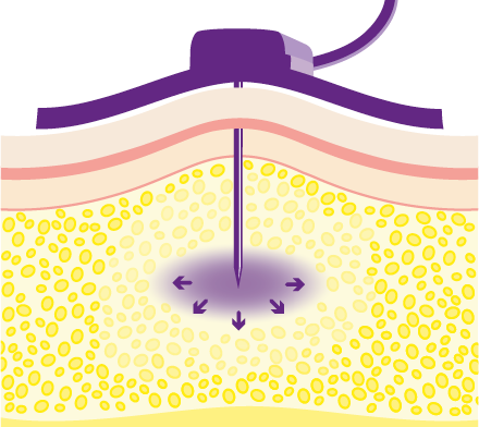 Werking hyaluronidase